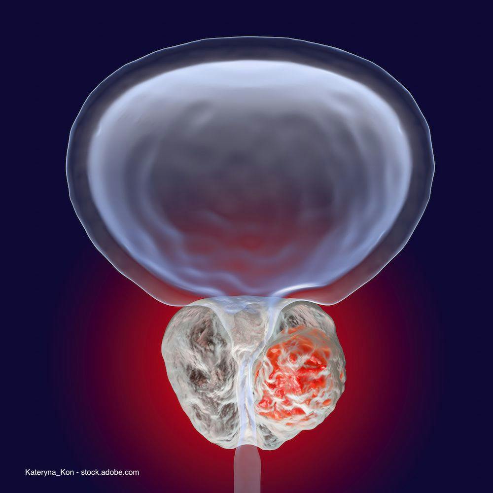 Nivolumab improves outcomes as adjuvant treatment in bladder cancer