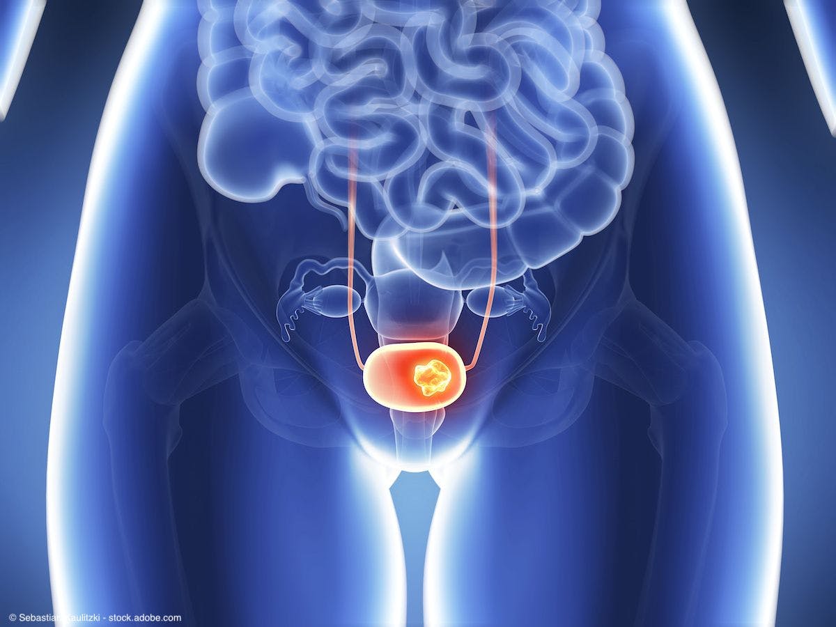 3d rendered illustration of bladder cancer | Image Credit: © Sebastian Kaulitzki - stock.adobe.com