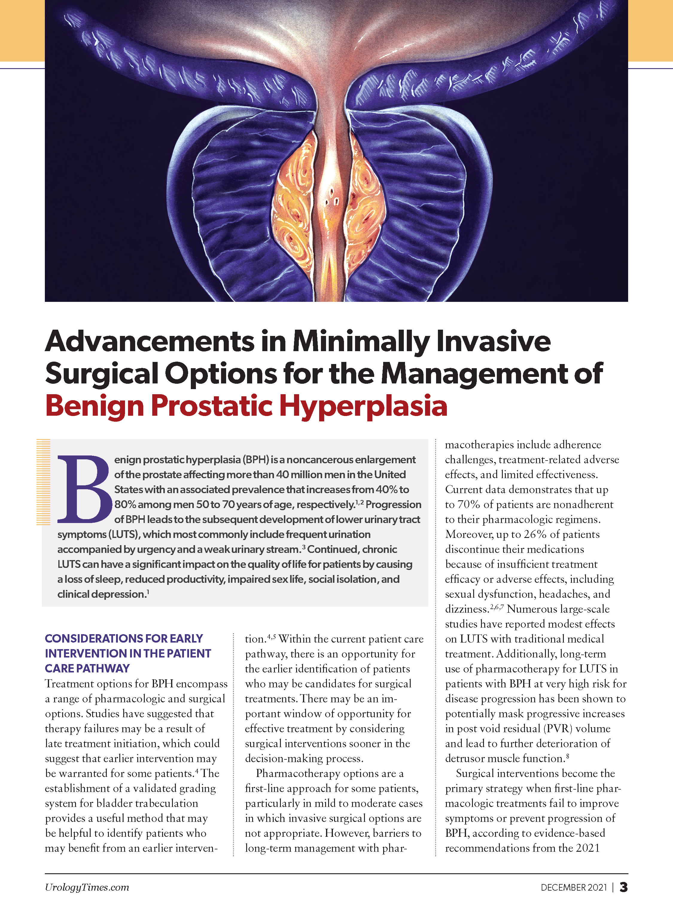 Advancements in Minimally Invasive Surgical Options for the Management of Benign Prostatic Hyperplasia